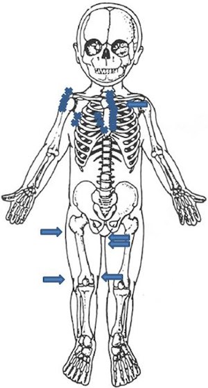 赤ちゃんの全身28箇所の骨を折ったに関連した画像-03